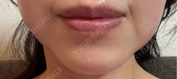 ボトックス（あご） Belle Via Skin Clinic DAY 11 メイン用