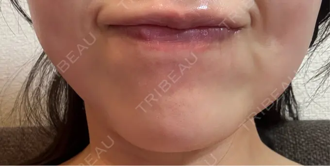 ボトックス（あご） Belle Via Skin Clinic DAY 11 メイン用