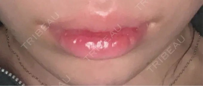 口唇縮小術 B-LINE CLINIC 池袋院 AFTER メイン用