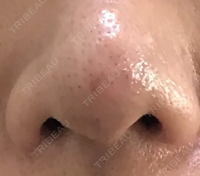 鼻尖形成（切開） 水の森美容クリニック 名古屋院 DAY 11 メイン用