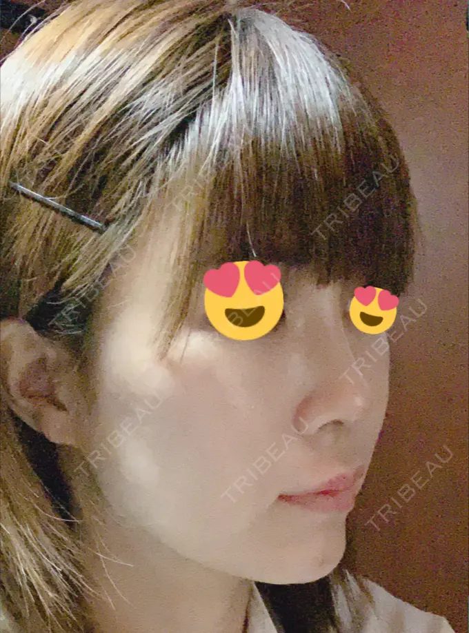 隆鼻術 / 鼻尖形成（切開） / 鼻中隔延長（切開） / 脂肪吸引（顔） / 軟骨移植 / プロテーゼ除去 / ヒアルロン酸注入（唇） ジュエリー美容外科 DAY 56 メイン用