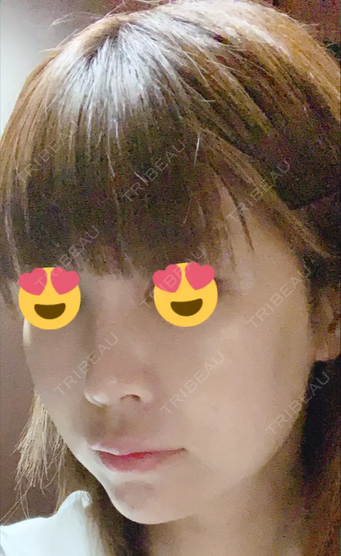 隆鼻術 / 鼻尖形成（切開） / 鼻中隔延長（切開） / 脂肪吸引（顔） / 軟骨移植 / プロテーゼ除去 / ヒアルロン酸注入（唇） ジュエリー美容外科 DAY 56 メイン用