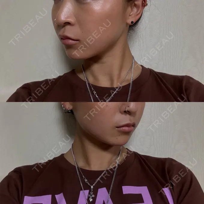 糸リフト / 脂肪吸引（顔） / 脂肪吸引注射（顔） ziz CLINIC DAY 91 メイン用