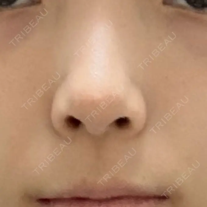 鼻孔縁下降 / その他（鼻） 聖心美容クリニック 銀座院 DAY 64 メイン用