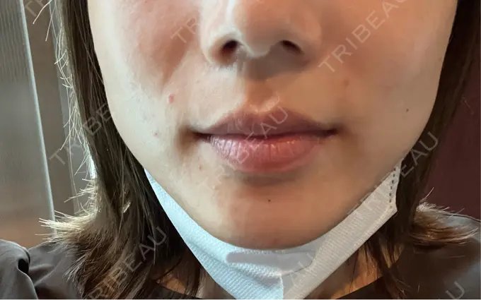 ピーリング（ニキビ・毛穴） / エレクトロポレーション / 毛穴洗浄（ハイドラフェイシャルなど） Casa de GRACIA GINZA 【カーサデグラシアギンザ】 DAY 0 メイン用