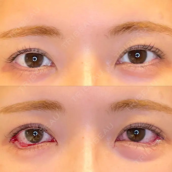 目尻切開 / 口角挙上 / タレ目形成・グラマラスライン（埋没） LOUIS CLINIC 二子玉川院【ルイクリニック】 DAY 0 メイン用