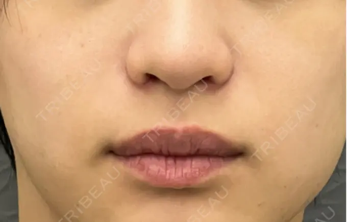 小鼻縮小（切開） 渋谷の森クリニック DAY 8 メイン用