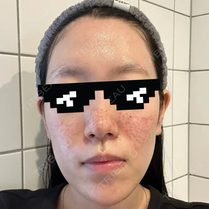 肌育注射（ジュベルックなど） / その他（肌） ゆきスキンクリニック 東池袋 DAY 0 メイン用