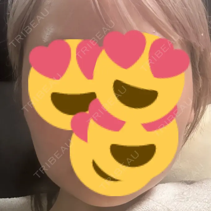 ボトックス（エラ・小顔） 椿クリニック 名古屋院 AFTER メイン用