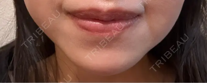 ボトックス（あご） Belle Via Skin Clinic DAY 12 メイン用