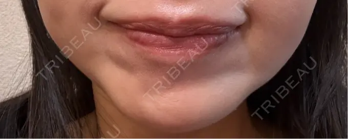 ボトックス（あご） Belle Via Skin Clinic DAY 12 メイン用