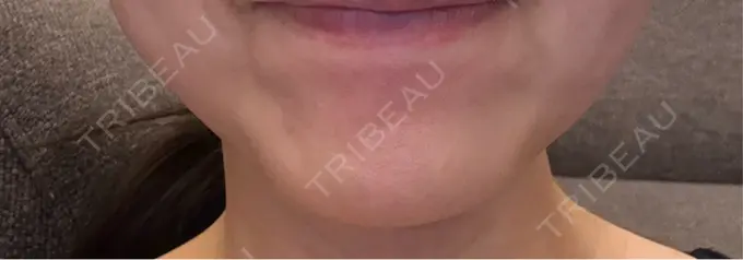 ボトックス（あご） Belle Via Skin Clinic DAY 13 メイン用