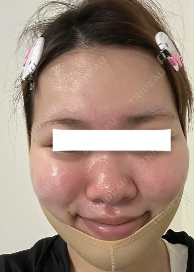 糸リフト / 脂肪吸引（顔） / ジョールファット除去 / 脂肪吸引注射（顔） / ボトックス（エラ・小顔） SEA CLINIC（シークリニック） DAY 5 メイン用