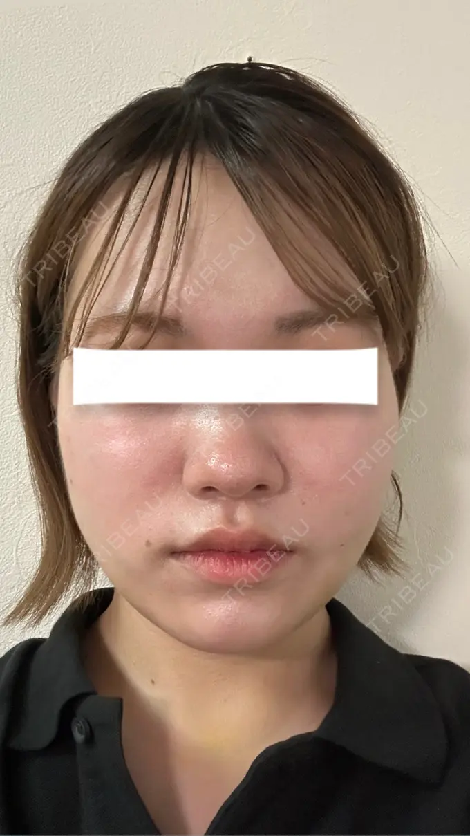 糸リフト / 脂肪吸引（顔） / ジョールファット除去 / 脂肪吸引注射（顔） / ボトックス（エラ・小顔） SEA CLINIC（シークリニック） DAY 6 メイン用