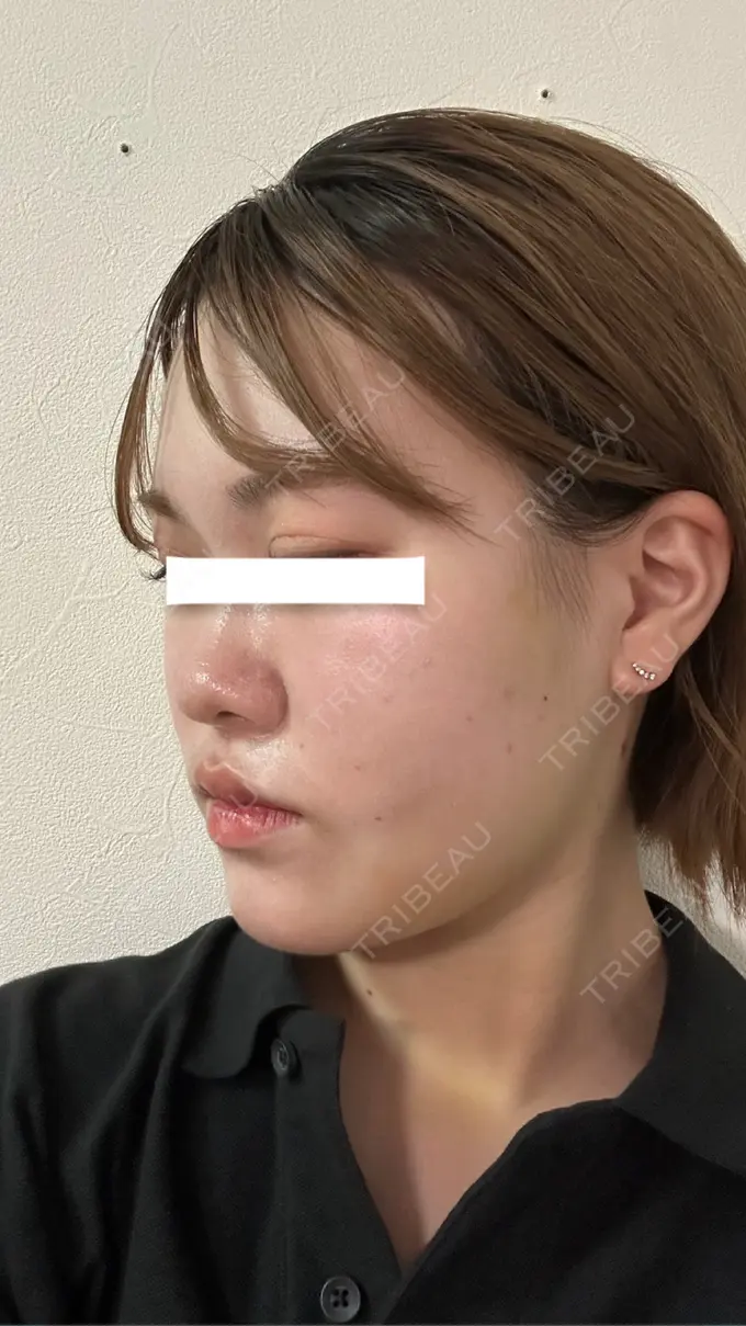 糸リフト / 脂肪吸引（顔） / ジョールファット除去 / 脂肪吸引注射（顔） / ボトックス（エラ・小顔） SEA CLINIC（シークリニック） DAY 6 メイン用