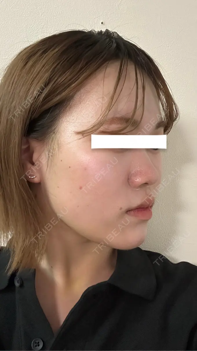 糸リフト / 脂肪吸引（顔） / ジョールファット除去 / 脂肪吸引注射（顔） / ボトックス（エラ・小顔） SEA CLINIC（シークリニック） DAY 6 メイン用