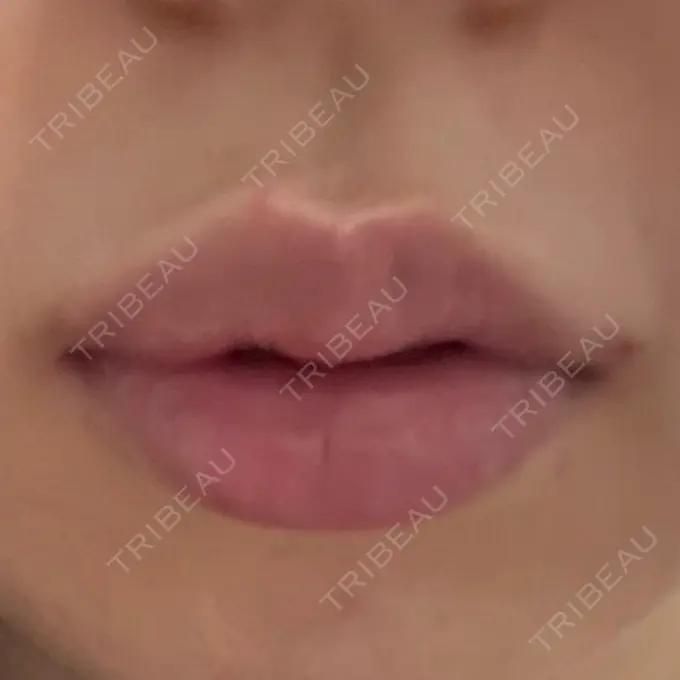 ヒアルロン酸注入（涙袋） / ヒアルロン酸注入（唇） 共立美容外科 熊本院 AFTER メイン用