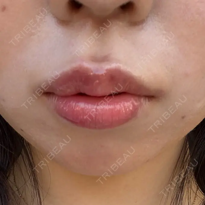 ヒアルロン酸注入（涙袋） / ヒアルロン酸注入（唇） 共立美容外科 熊本院 DAY 0 メイン用