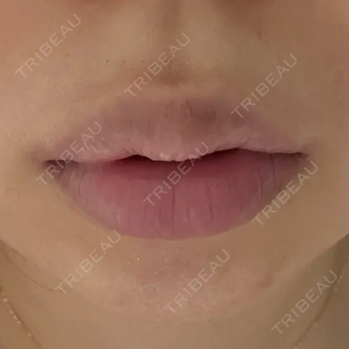 ヒアルロン酸注入（涙袋） / ヒアルロン酸注入（唇） 共立美容外科 熊本院 DAY 0 メイン用