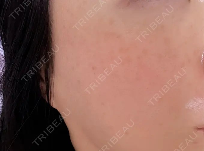 イオン導入 / ピーリング（ハリ・ツヤ） / ルメッカ ルラ美容クリニック 名古屋栄院 / ルラスキンクリニック 名古屋栄院 DAY 9 メイン用