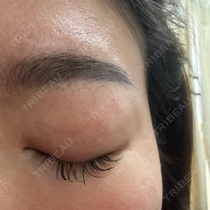 上まぶたの脂肪取り 湘南美容クリニック 大阪四ツ橋院 AFTER メイン用