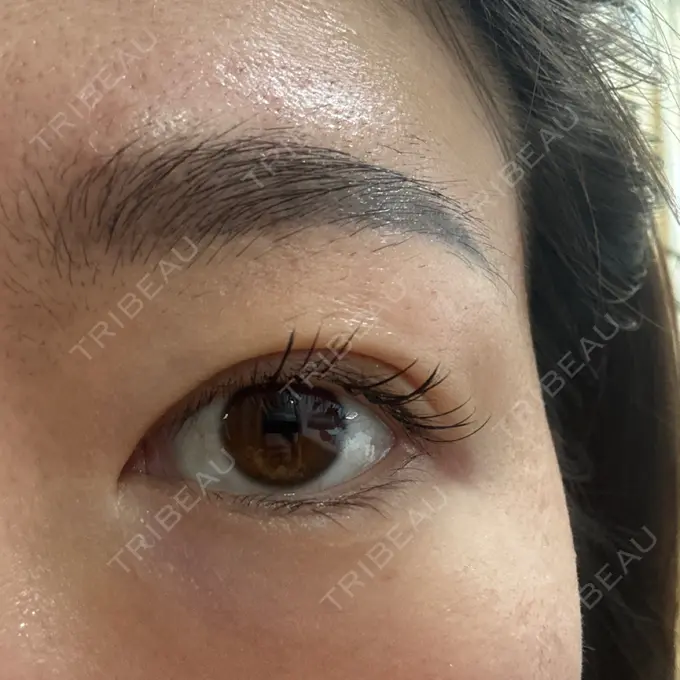 上まぶたの脂肪取り 湘南美容クリニック 大阪四ツ橋院 DAY 7 メイン用