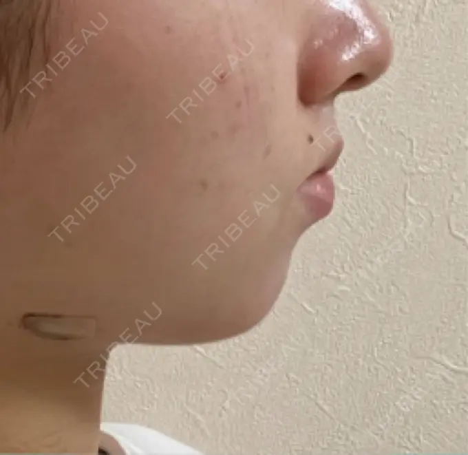 クマ治療 / ボトックス（あご） / ボトックス（エラ・小顔） HAAB BEAUTY CLINIC 名古屋院 DAY 74 メイン用