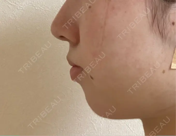 クマ治療 / ボトックス（あご） / ボトックス（エラ・小顔） HAAB BEAUTY CLINIC 名古屋院 DAY 74 メイン用