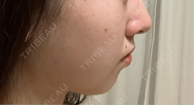 クマ治療 / ボトックス（あご） / ボトックス（エラ・小顔） HAAB BEAUTY CLINIC 名古屋院 DAY 87 メイン用