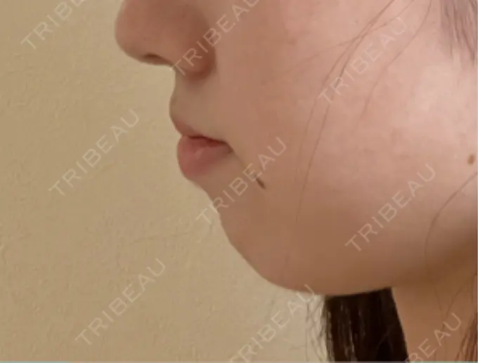 クマ治療 / ボトックス（あご） / ボトックス（エラ・小顔） HAAB BEAUTY CLINIC 名古屋院 DAY 98 メイン用