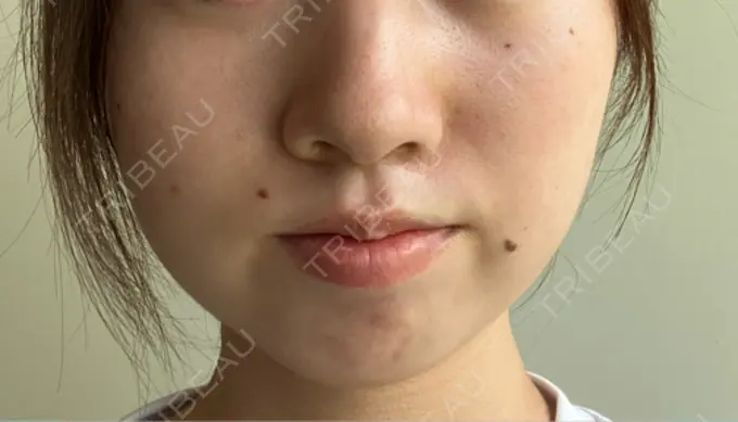 クマ治療 / ボトックス（あご） / ボトックス（エラ・小顔） HAAB BEAUTY CLINIC 名古屋院 DAY 79 メイン用