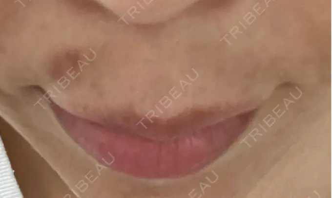 クマ治療 / 下まぶたの脂肪取り / ヒアルロン酸注入（唇） / ボトックス（口角） TCB東京中央美容外科 仙台駅前院 DAY 5 メイン用