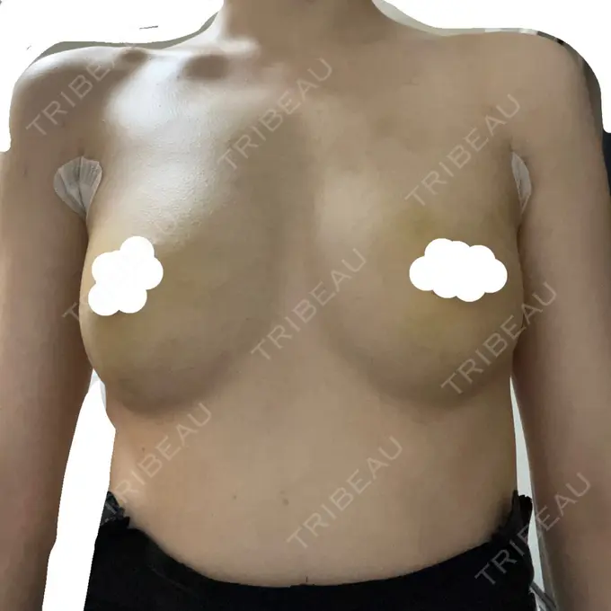 脂肪吸引（脚） / 豊胸（脂肪注入） / 胸修正 / 脂肪吸引（腰） Lipo Clinic omotesando DAY 3 メイン用