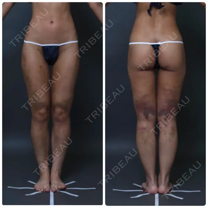 脂肪吸引（脚） THE CLINIC（ザ・クリニック） 名古屋院 DAY 7 メイン用