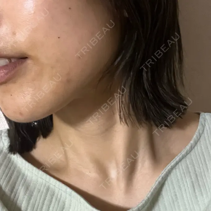 ピーリング（ニキビ・毛穴） / エレクトロポレーション / 毛穴洗浄（ハイドラフェイシャルなど） Casa de GRACIA GINZA 【カーサデグラシアギンザ】 DAY 1 メイン用