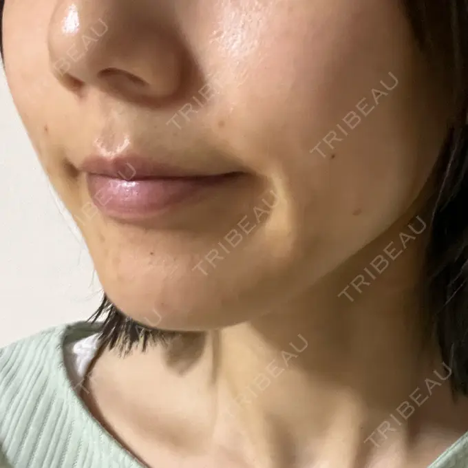 ピーリング（ニキビ・毛穴） / エレクトロポレーション / 毛穴洗浄（ハイドラフェイシャルなど） Casa de GRACIA GINZA 【カーサデグラシアギンザ】 DAY 1 メイン用