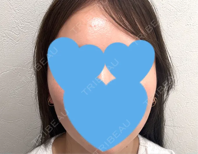 糸リフト / シワ取りボトックス / ボトックス（眉間） アリエル美容クリニック 横浜院 DAY 23 メイン用