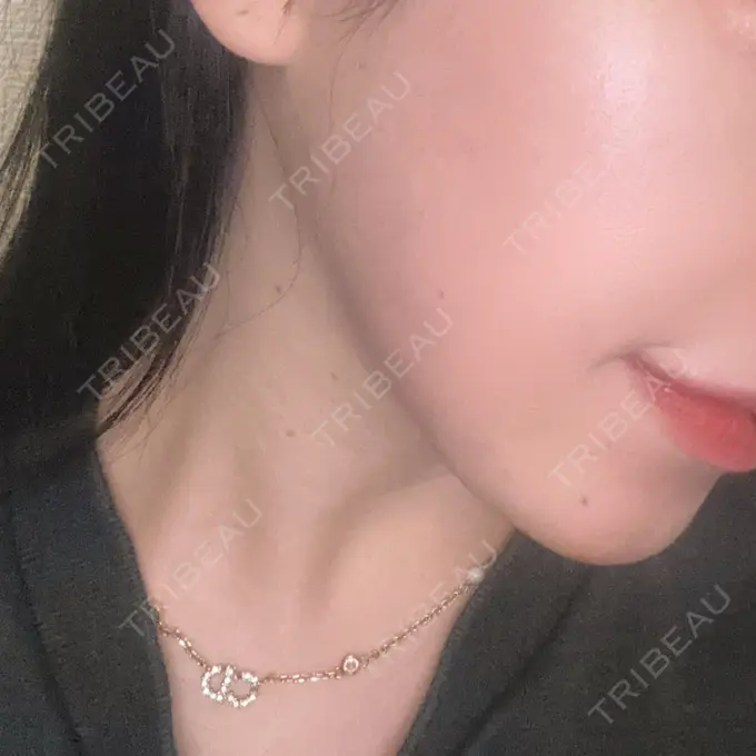 RF（高周波）たるみ治療 大美会クリニック 梅田院 AFTER メイン用