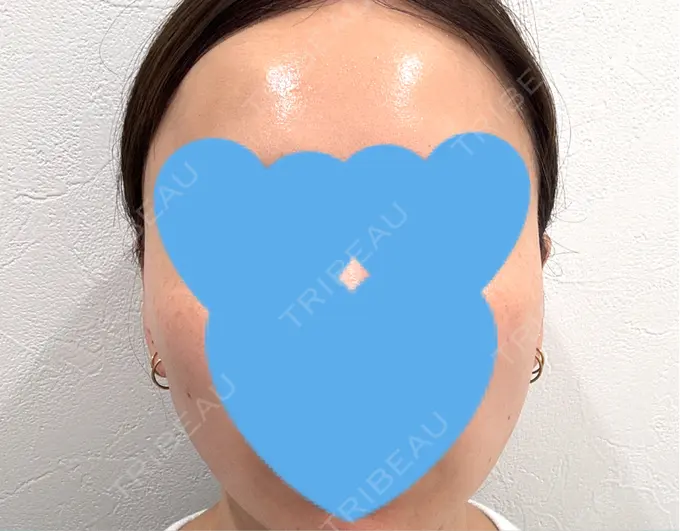 糸リフト / シワ取りボトックス / ボトックス（眉間） アリエル美容クリニック 横浜院 DAY 24 メイン用