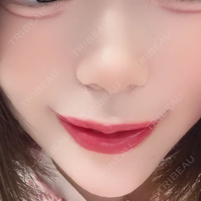 ヒアルロン酸注入（あご） / ヒアルロン酸注入（唇） / ボトックス（口角） ルラ美容クリニック 高田馬場院 DAY 1 メイン用