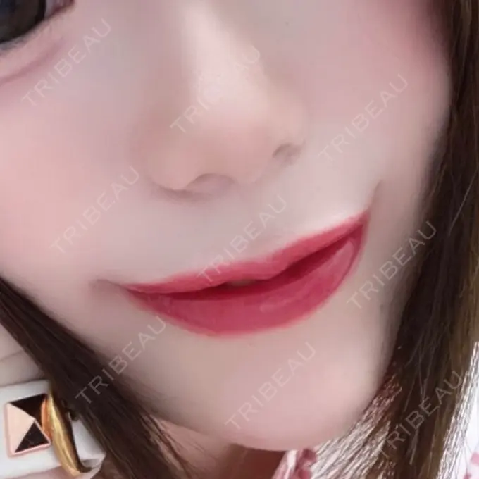 ヒアルロン酸注入（あご） / ヒアルロン酸注入（唇） / ボトックス（口角） ルラ美容クリニック 高田馬場院 DAY 1 メイン用