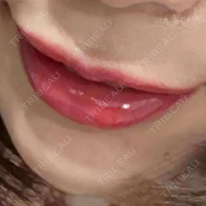 ヒアルロン酸注入（あご） / ヒアルロン酸注入（唇） / ボトックス（口角） ルラ美容クリニック 高田馬場院 DAY 2 メイン用