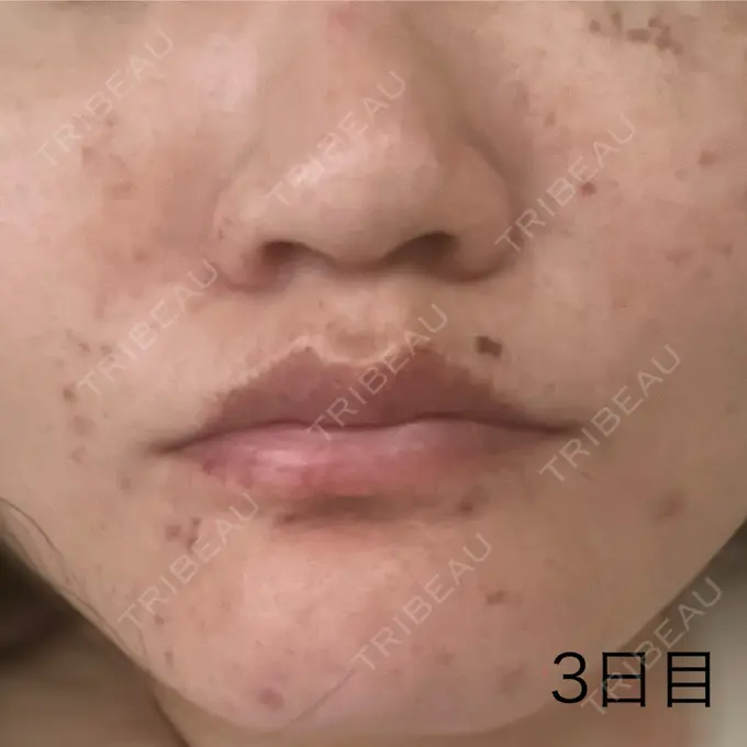 ピコレーザートーニング（美白・肝斑） 東京シルククリニック 東京神田院 DAY 2 メイン用