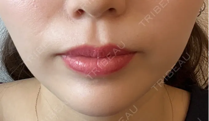 ボトックス（口角） ルラ美容クリニック 広島院 DAY 17 メイン用