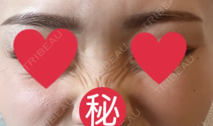 ボトックス（バニーライン） 共立美容外科 広島院 DAY 14 メイン用