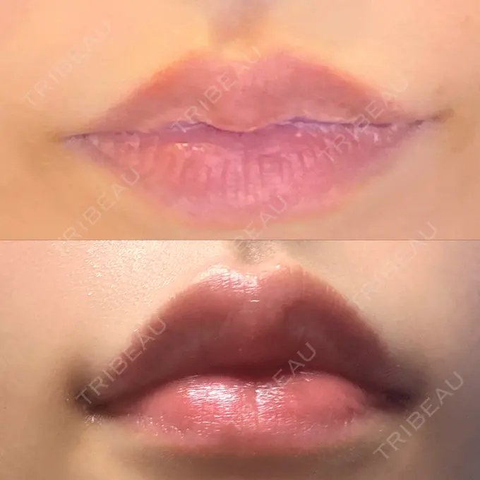 目尻切開 / 口角挙上 / タレ目形成・グラマラスライン（埋没） LOUIS CLINIC 二子玉川院【ルイクリニック】 DAY 3 メイン用