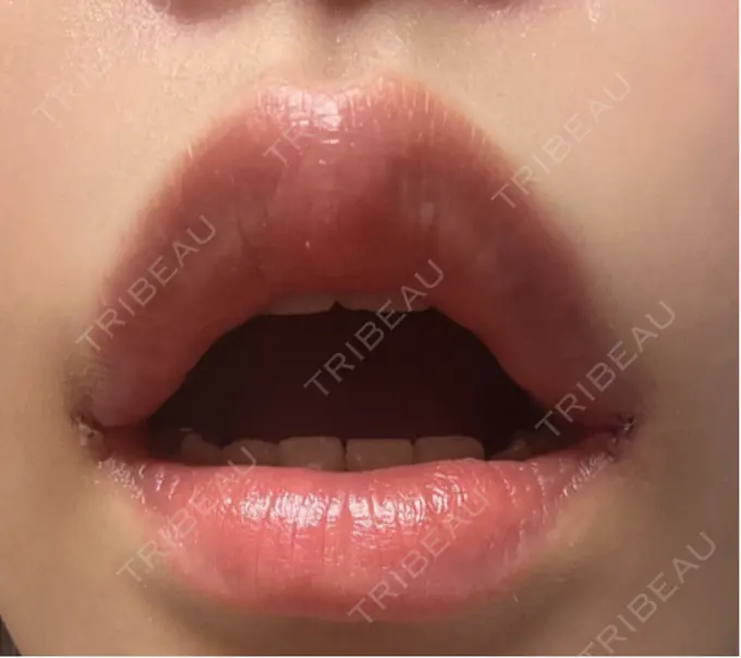 目尻切開 / 口角挙上 / タレ目形成・グラマラスライン（埋没） LOUIS CLINIC 二子玉川院【ルイクリニック】 DAY 3 メイン用