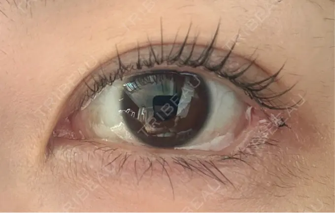 目尻切開 / 口角挙上 / タレ目形成・グラマラスライン（埋没） LOUIS CLINIC 二子玉川院【ルイクリニック】 DAY 1 メイン用