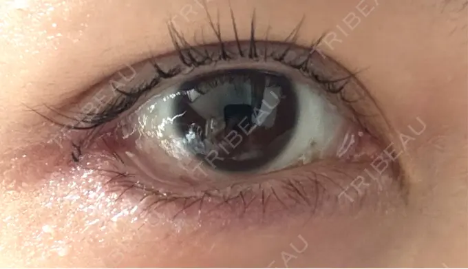 目尻切開 / 口角挙上 / タレ目形成・グラマラスライン（埋没） LOUIS CLINIC 二子玉川院【ルイクリニック】 DAY 1 メイン用