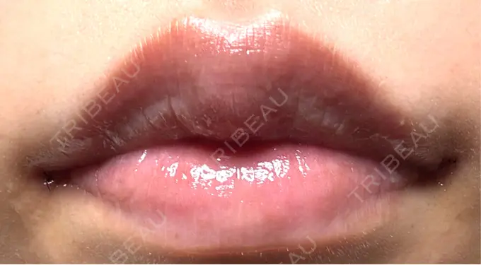 目尻切開 / 口角挙上 / タレ目形成・グラマラスライン（埋没） LOUIS CLINIC 二子玉川院【ルイクリニック】 DAY 1 メイン用